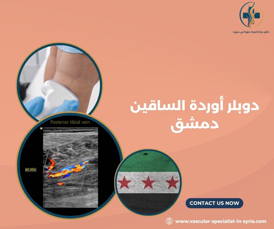 دوبلر أوردة الساقين دمشق دوبلر أوردة الساقين دمشق