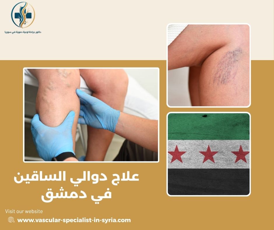علاج دوالي الساقين في دمشق علاج دوالي الساقين في دمشق