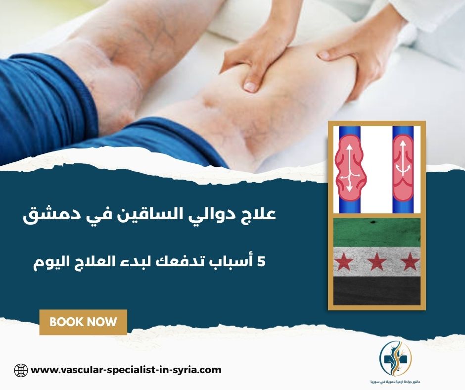 علاج دوالي الساقين في دمشق
