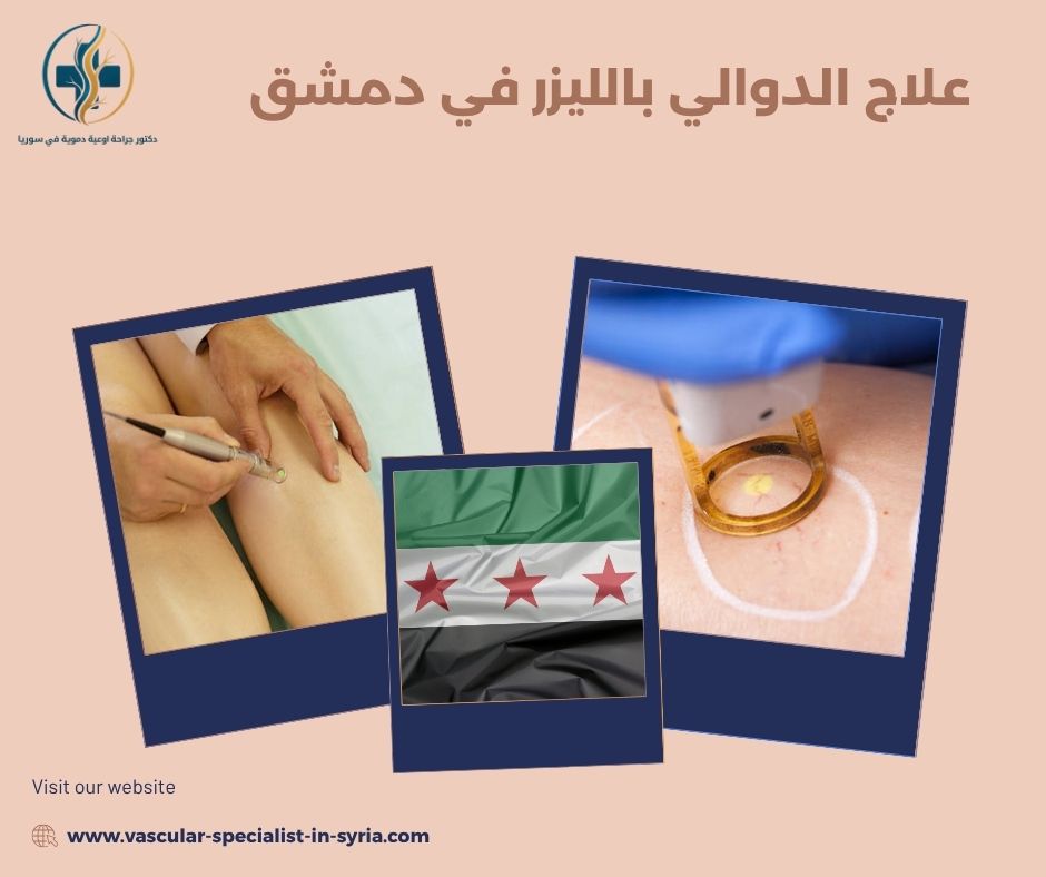 علاج الدوالي بالليزر في دمشق علاج الدوالي بالليزر في دمشق