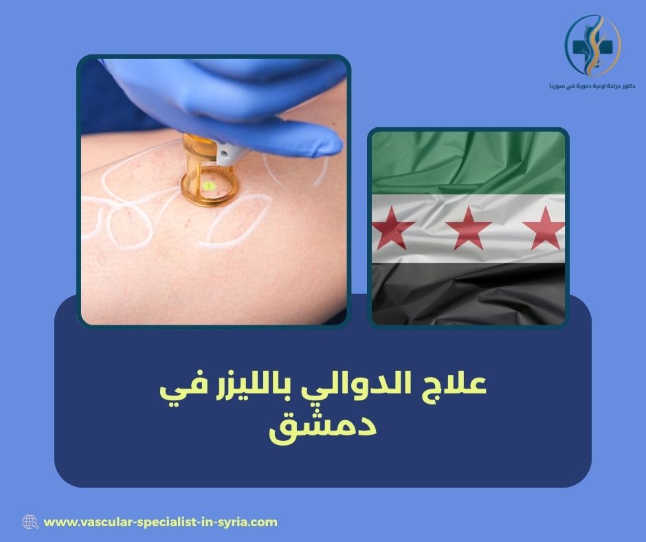 علاج الدوالي بالليزر في دمشق علاج الدوالي بالليزر في دمشق