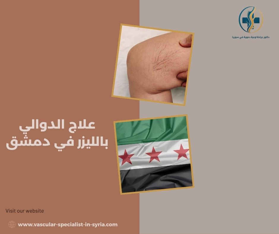 ما المقصود بعلاج الدوالي بالليزر؟ ما المقصود بعلاج الدوالي بالليزر؟