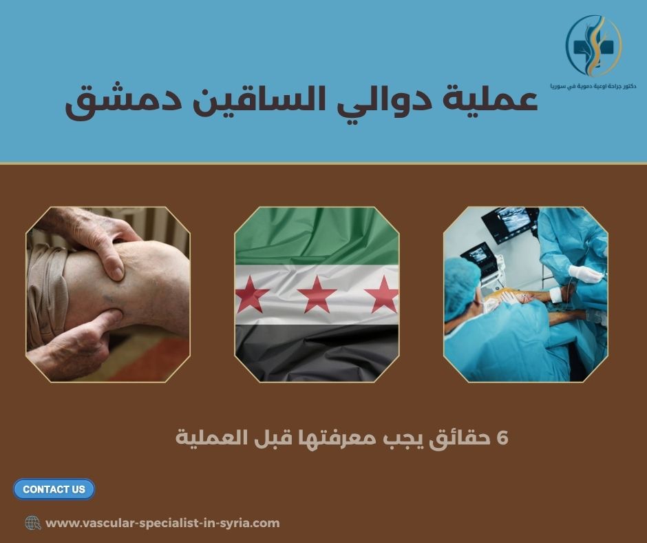 عملية دوالي الساقين دمشق