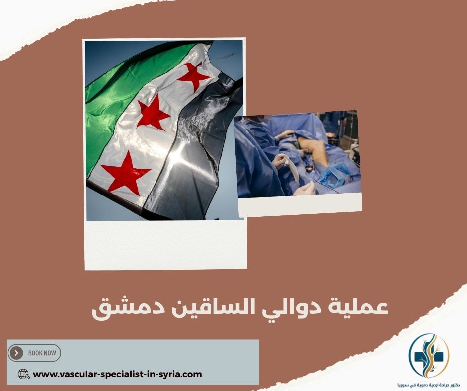 عملية دوالي الساقين دمشق عملية دوالي الساقين دمشق