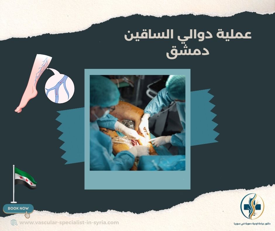 عملية دوالي الساقين دمشق عملية دوالي الساقين دمشق