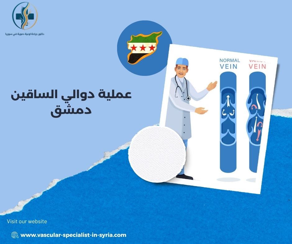 الفحوصات المطلوبة قبل قرار عملية الدوالي الفحوصات المطلوبة قبل قرار عملية الدوالي