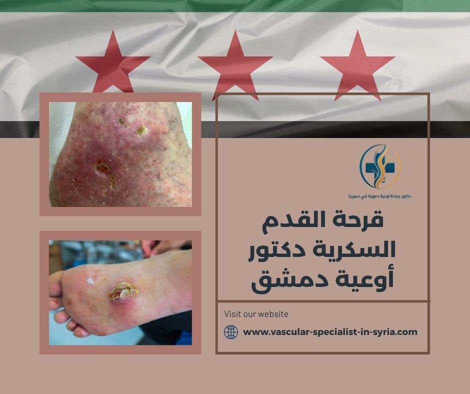 قرحة القدم السكرية دكتور أوعية دمشق قرحة القدم السكرية دكتور أوعية دمشق