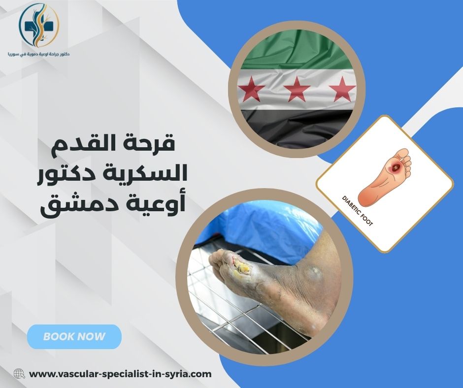 قرحة القدم السكرية دكتور أوعية دمشق قرحة القدم السكرية دكتور أوعية دمشق