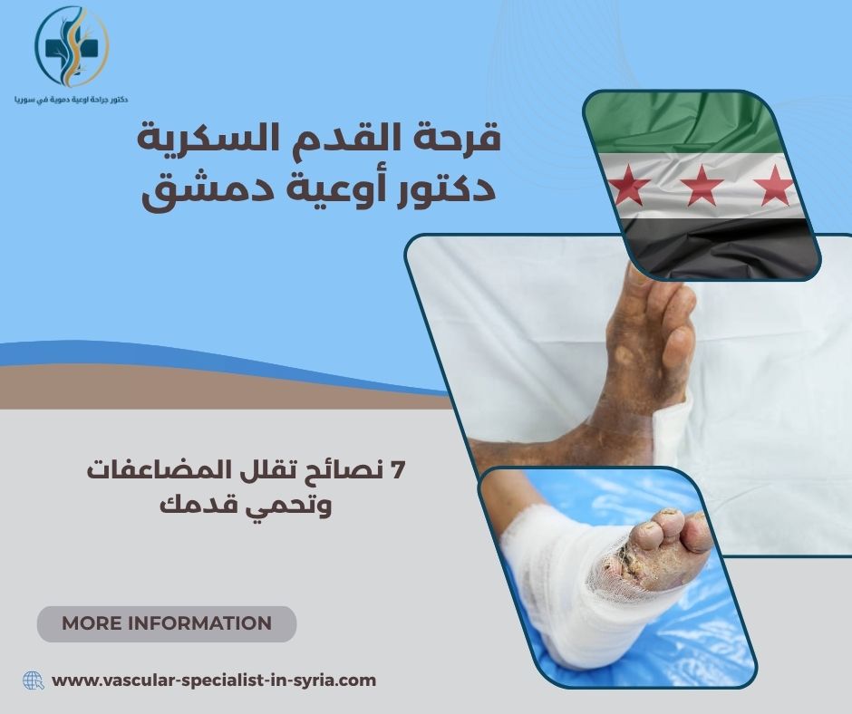 قرحة القدم السكرية دكتور أوعية دمشق