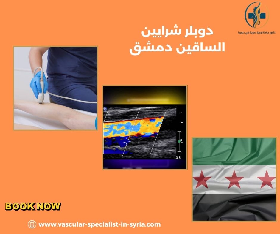 دوبلر شرايين الساقين دمشق
