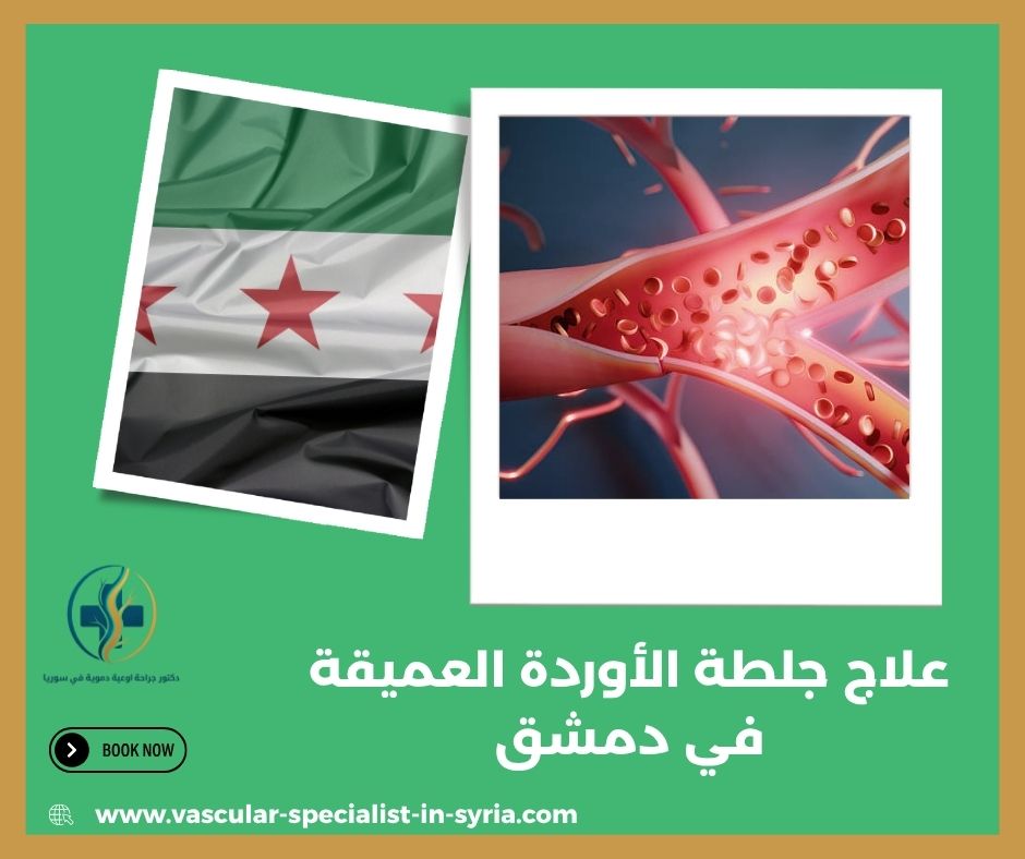 ما المقصود بجلطة الأوردة العميقة؟ ما المقصود بجلطة الأوردة العميقة؟