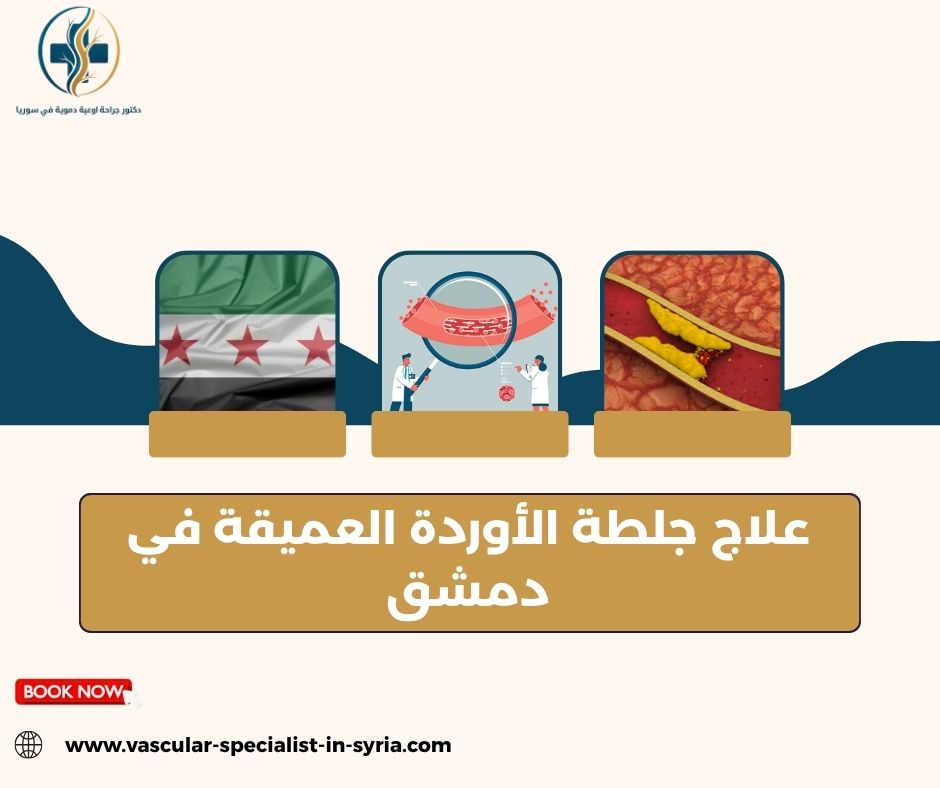 علاج جلطة الأوردة العميقة في دمشق علاج جلطة الأوردة العميقة في دمشق