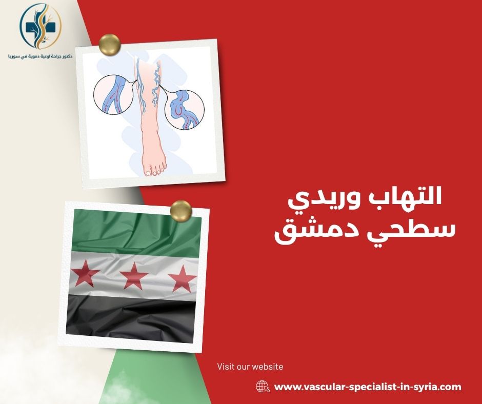 التهاب وريدي سطحي دمشق التهاب وريدي سطحي دمشق