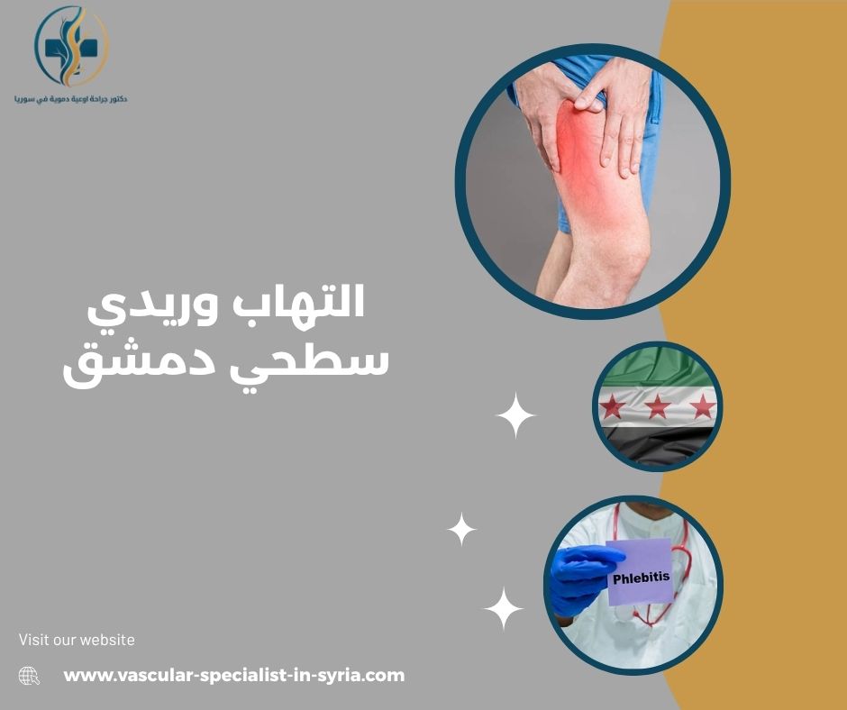 التهاب وريدي سطحي دمشق التهاب وريدي سطحي دمشق