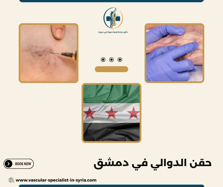 حقن الدوالي في دمشق