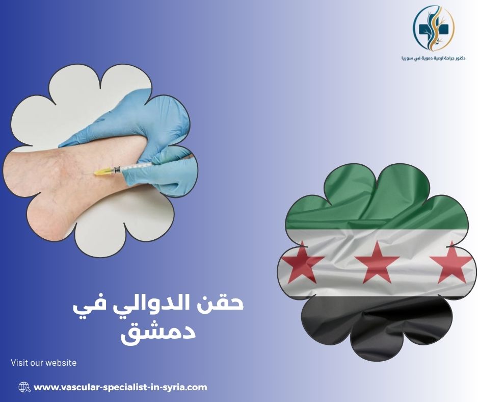 حقن الدوالي في دمشق