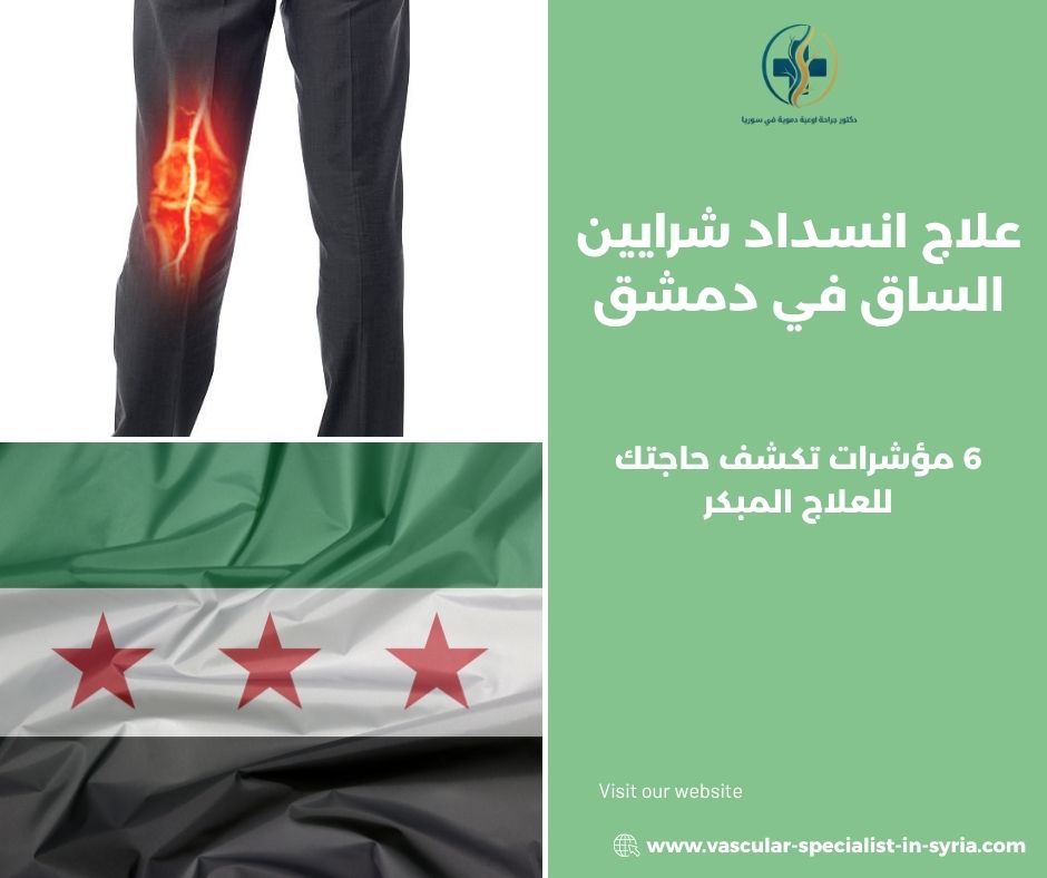 علاج انسداد شرايين الساق في دمشق