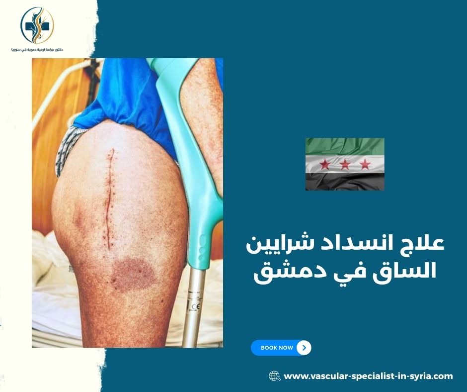 برودة القدم وتغير اللون وضعف النبض برودة القدم وتغير اللون وضعف النبض