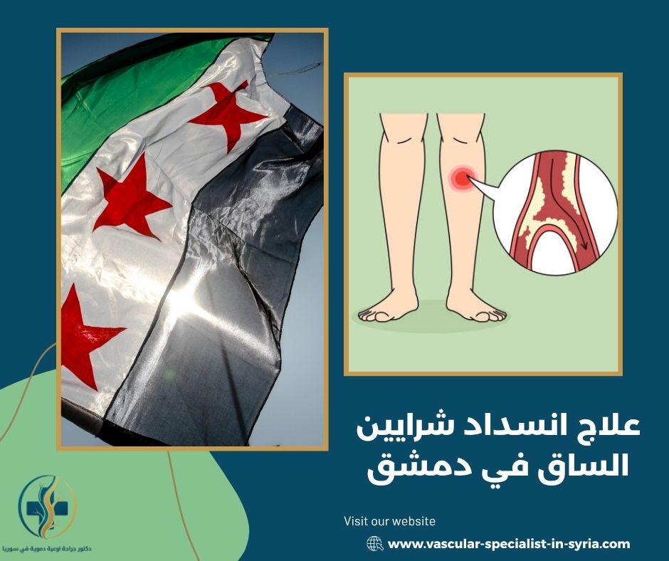 علاج انسداد شرايين الساق في دمشق علاج انسداد شرايين الساق في دمشق