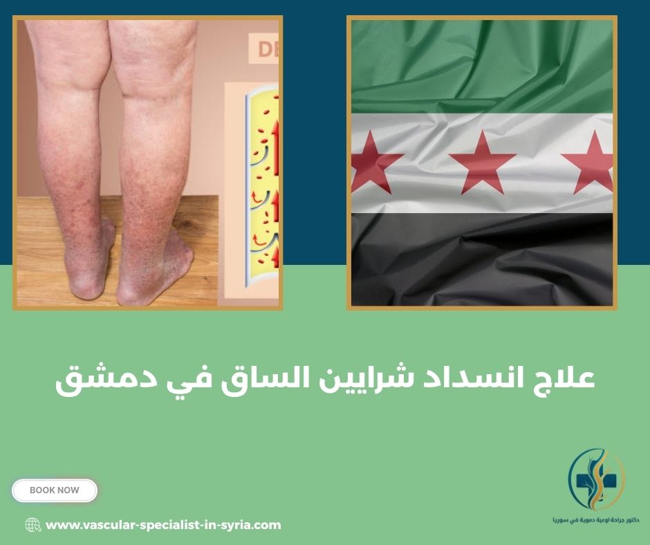 علاج انسداد شرايين الساق في دمشق علاج انسداد شرايين الساق في دمشق