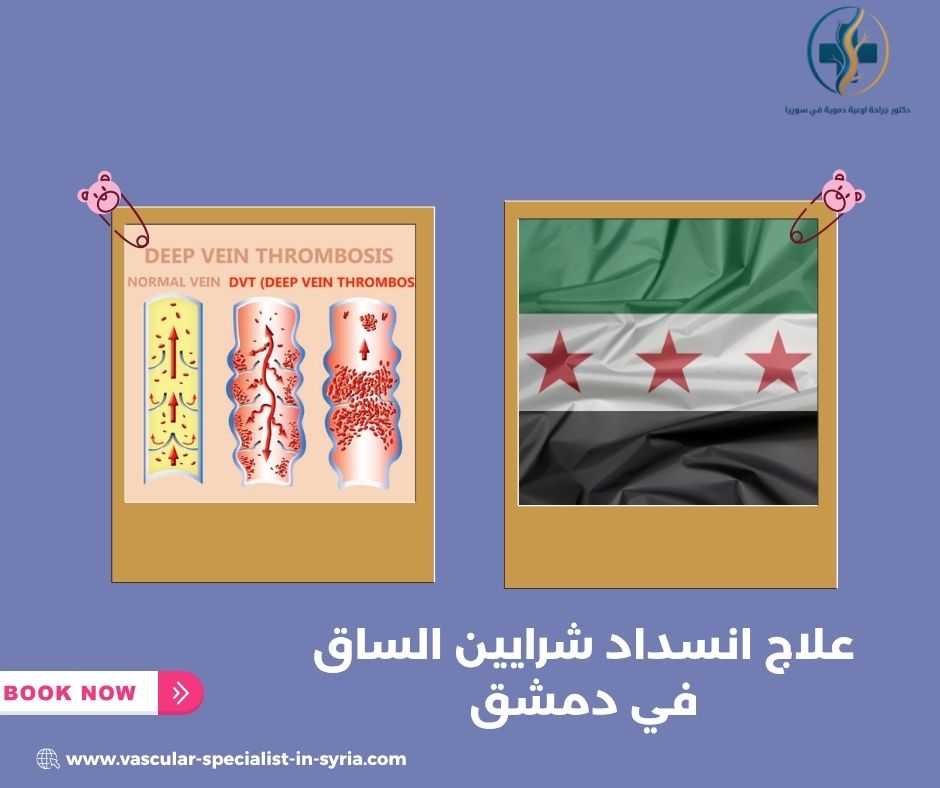 ما أعراض انسداد شرايين الساق؟ ما أعراض انسداد شرايين الساق؟