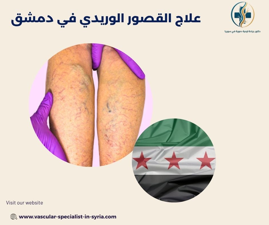 علامات ضعف صمامات الأوردة في الساقين علامات ضعف صمامات الأوردة في الساقين