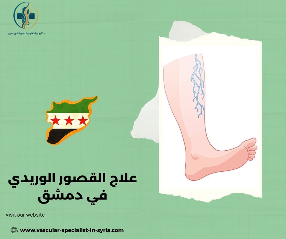 علاج القصور الوريدي في دمشق علاج القصور الوريدي في دمشق