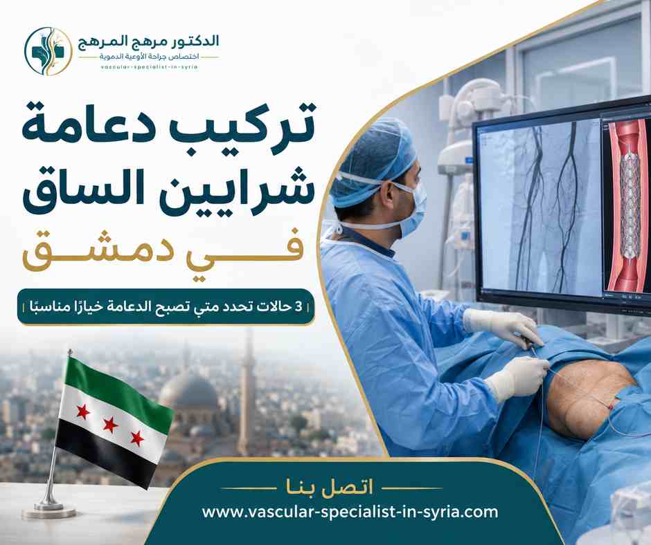 تركيب دعامة شرايين الساق في دمشق