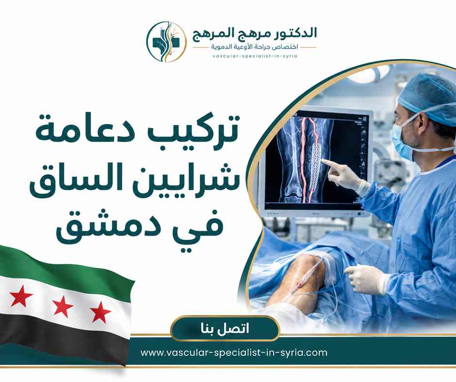 تركيب دعامة شرايين الساق في دمشق تركيب دعامة شرايين الساق في دمشق