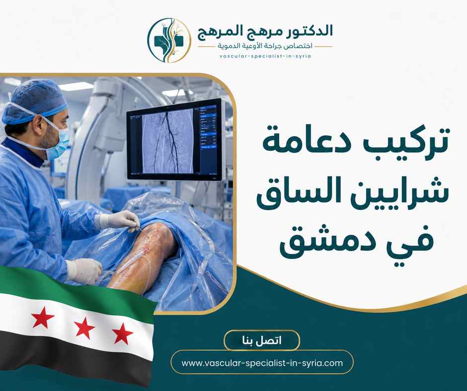 تركيب دعامة شرايين الساق في دمشق تركيب دعامة شرايين الساق في دمشق
