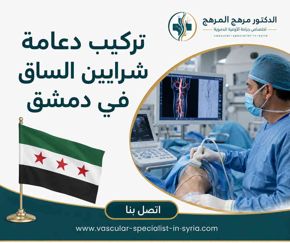 تركيب دعامة شرايين الساق في دمشق تركيب دعامة شرايين الساق في دمشق
